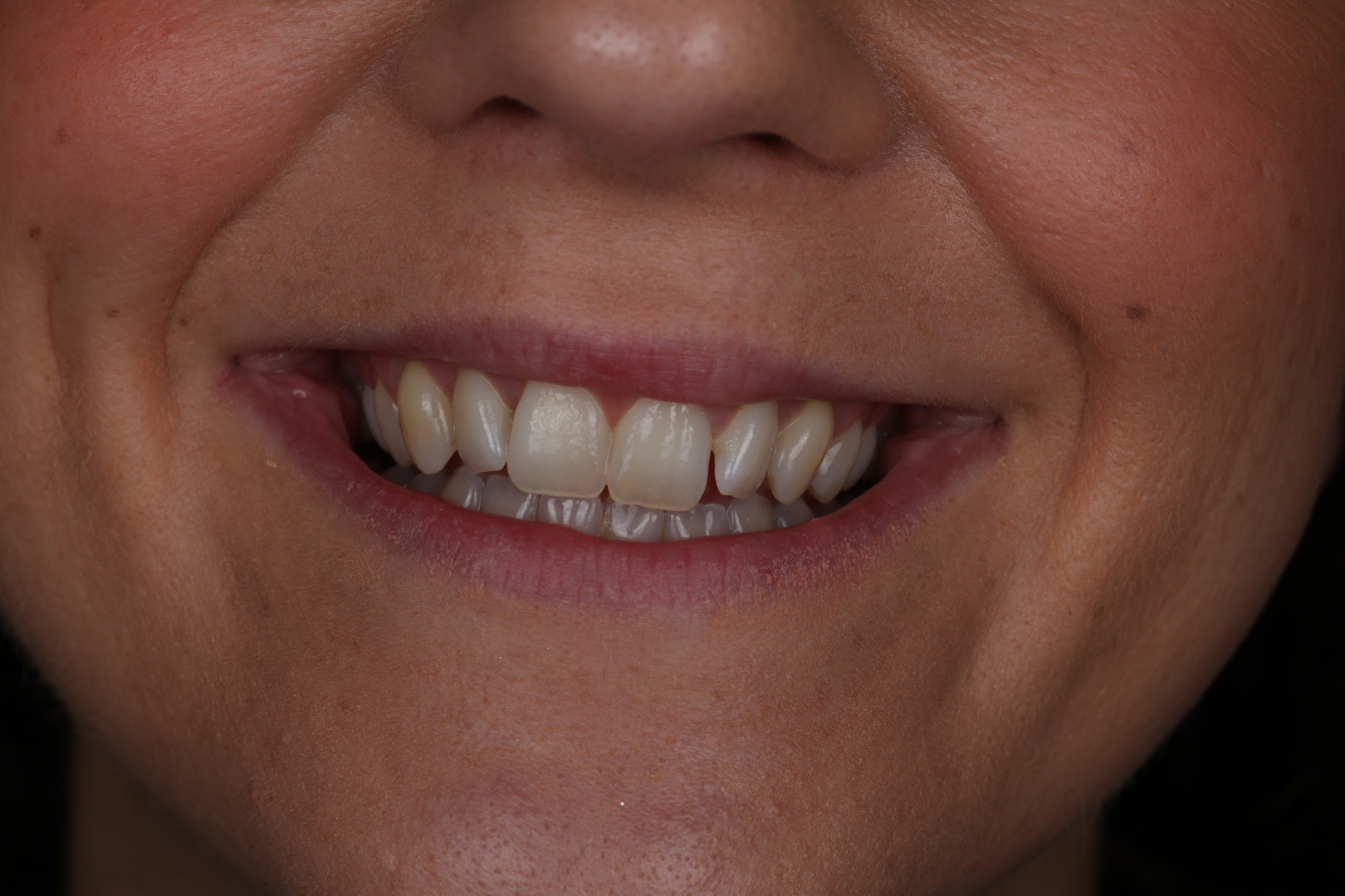 Case 04, before, smile detail