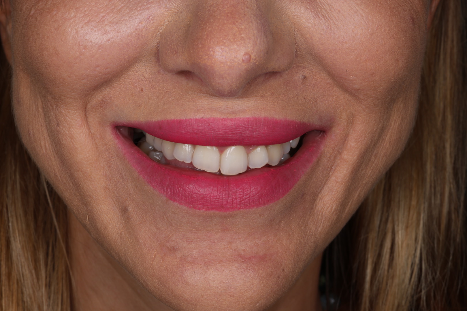 Case 03, before, smile detail