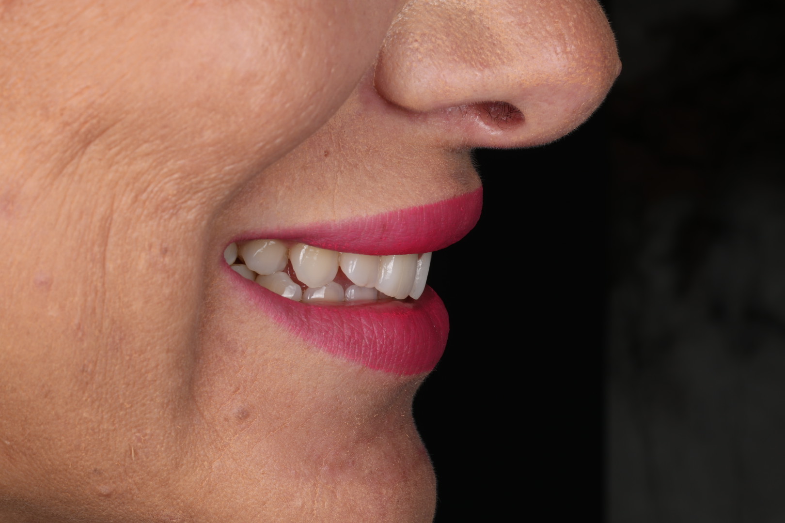 Case 03, before, smile detail