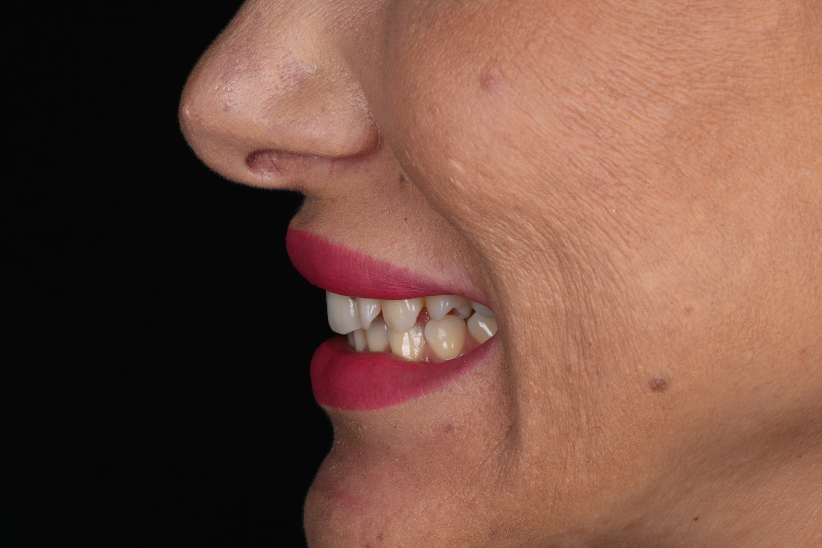 Case 03, before, smile detail