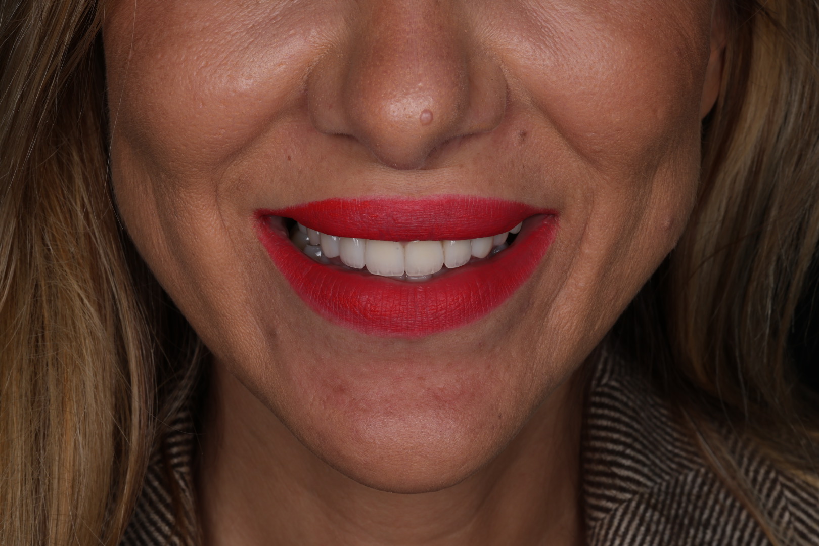 Case 03, after, smile detail