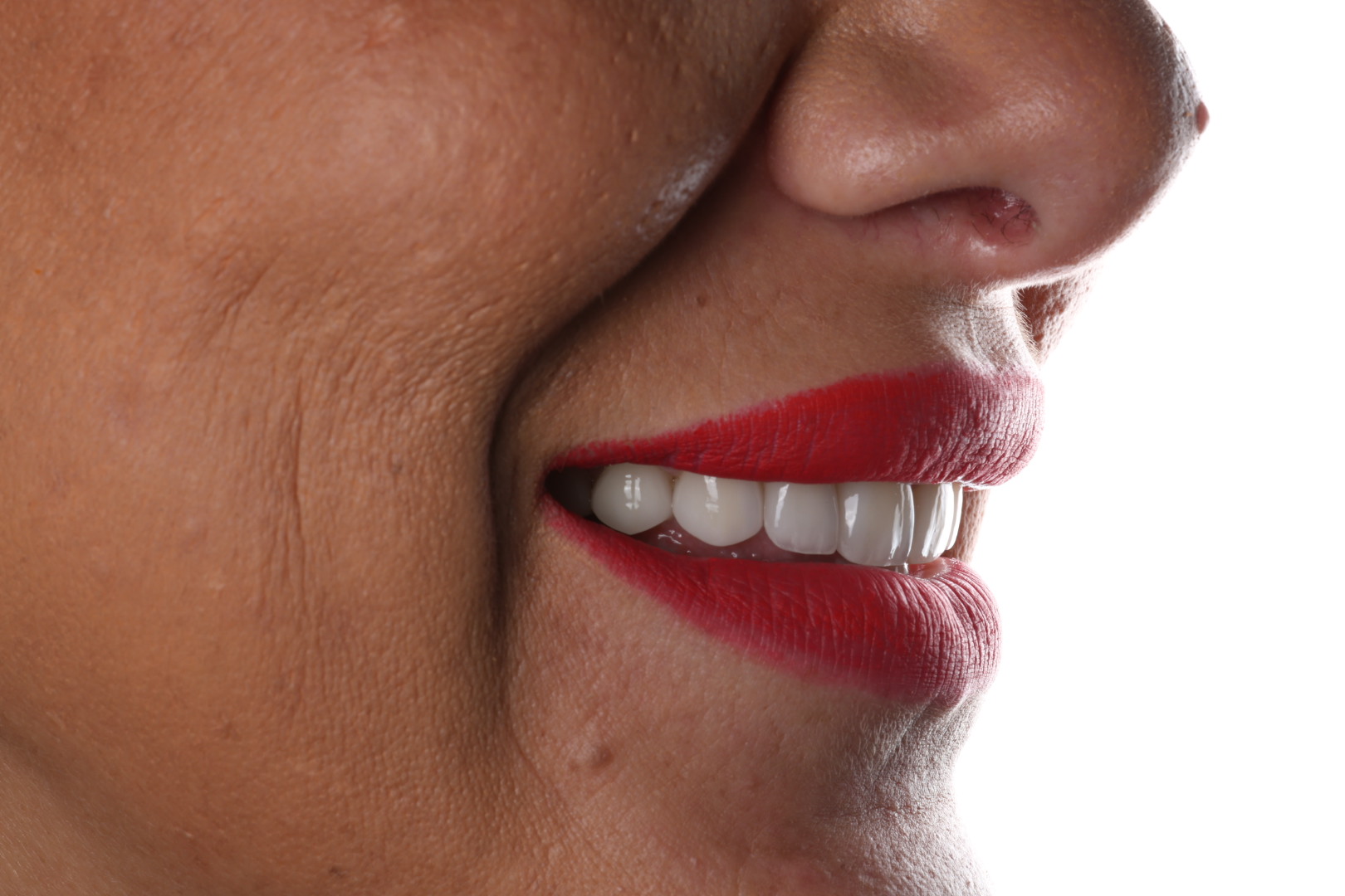 Case 03, after, smile detail
