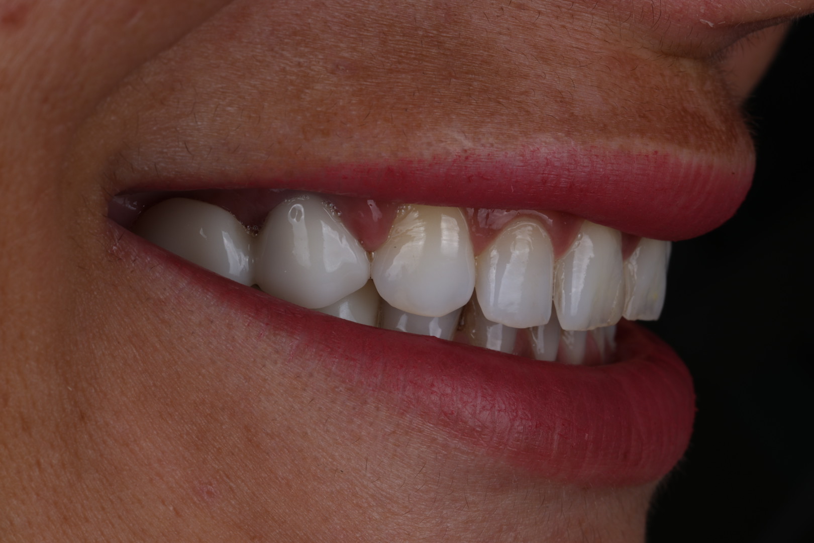 Case 01, before, angled smile view