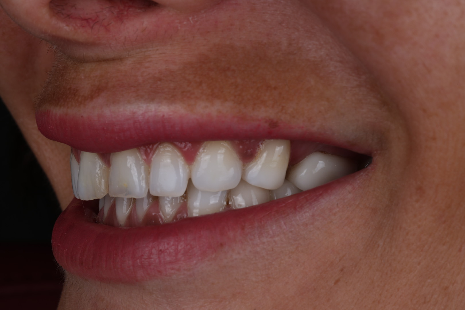 Case 01, before, opposite angled smile view