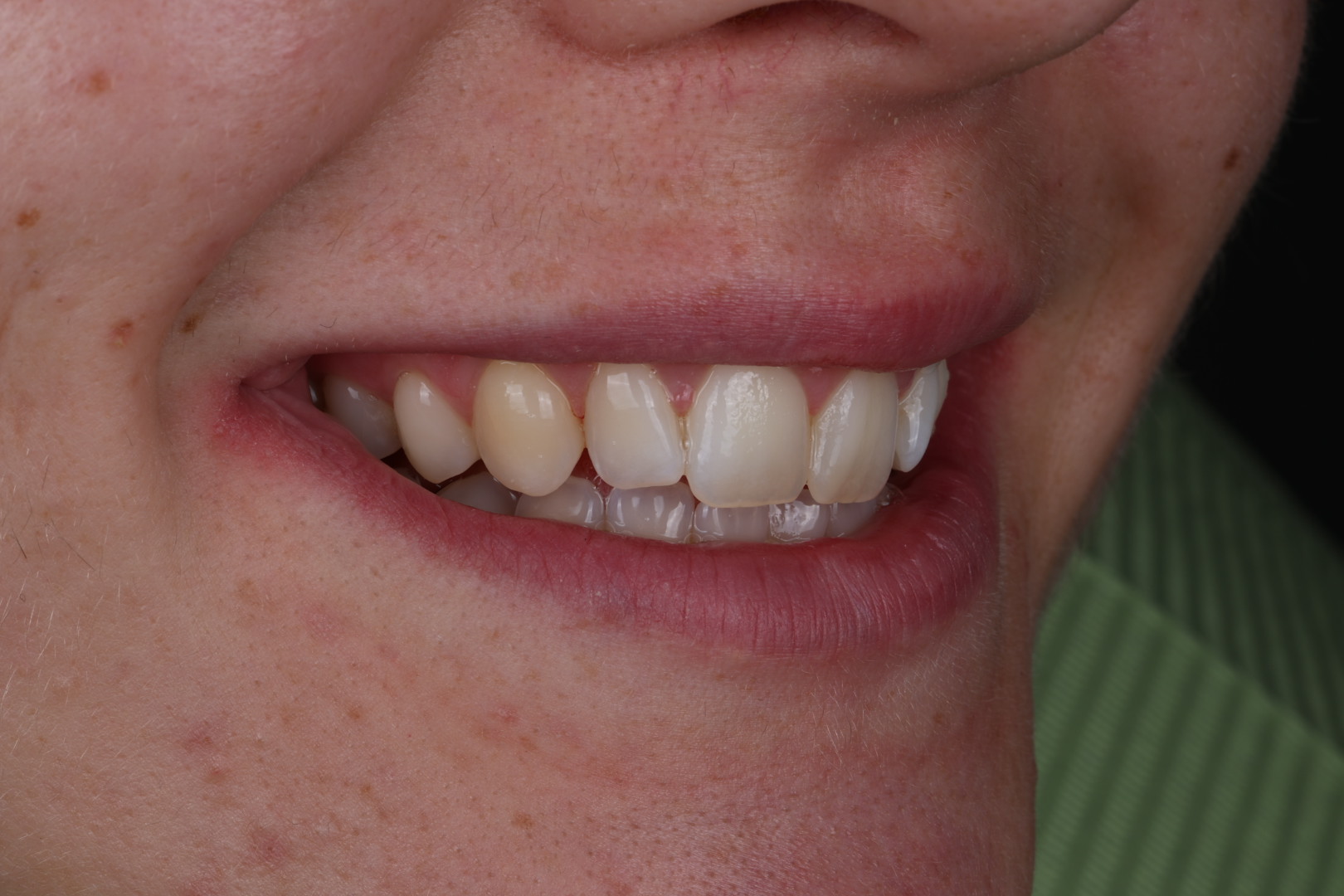 Case 04, before, smile detail