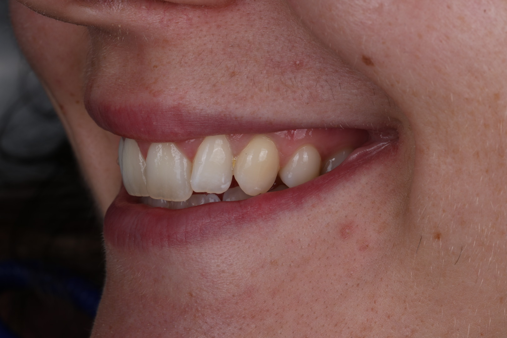 Case 04, before, smile detail