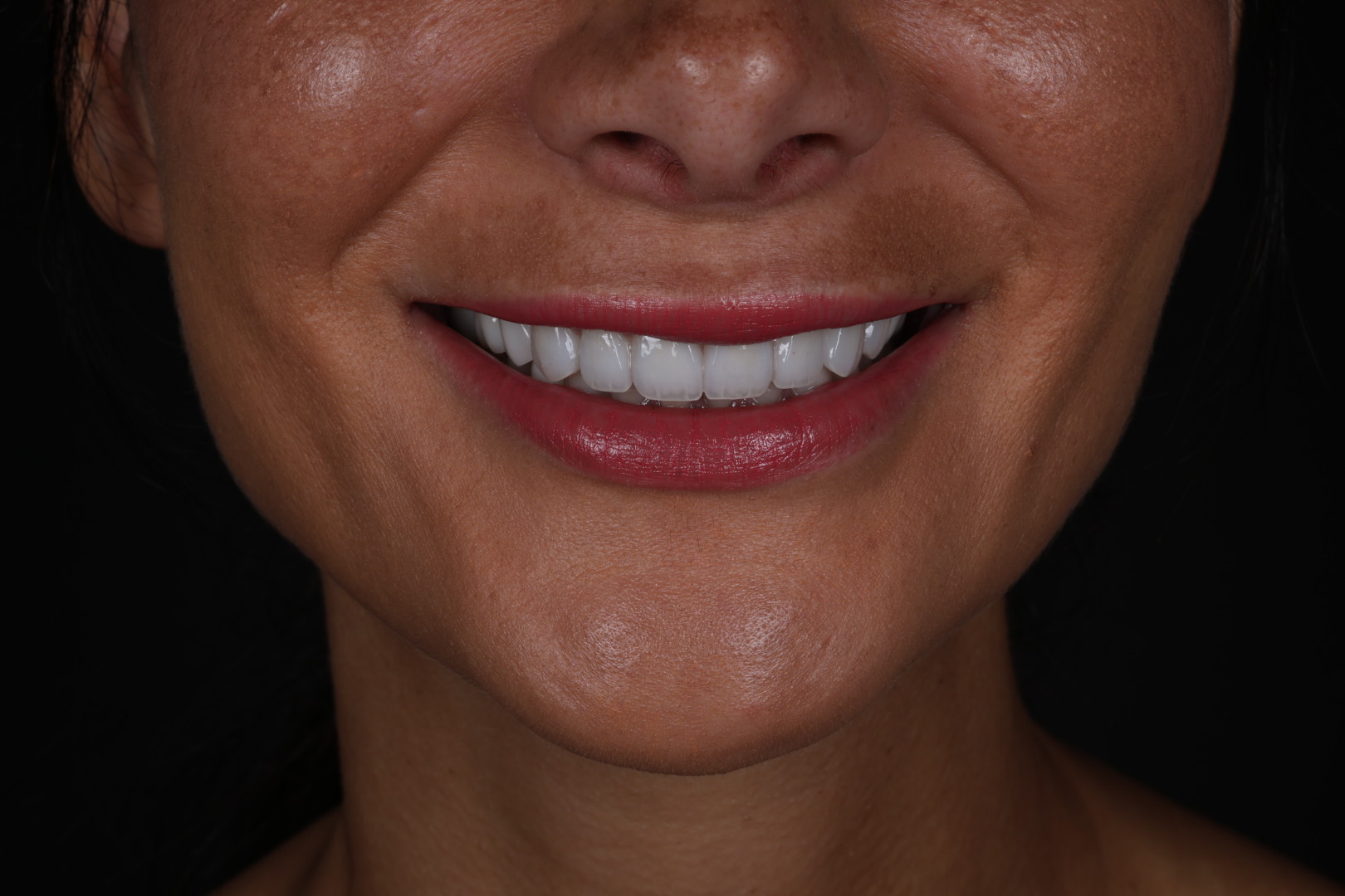 Case 01, after, front smile view