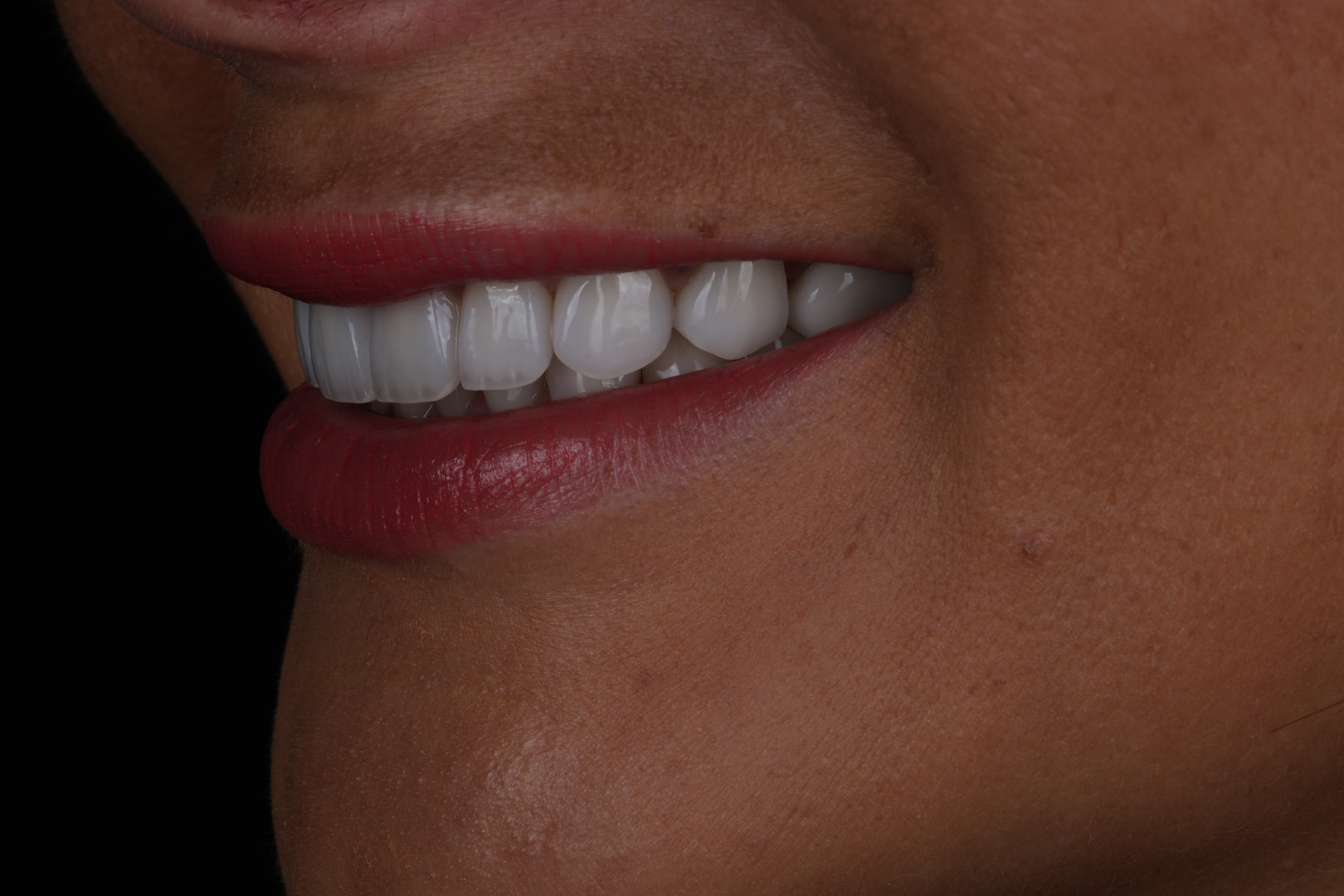 Case 01, after, opposite angled smile view