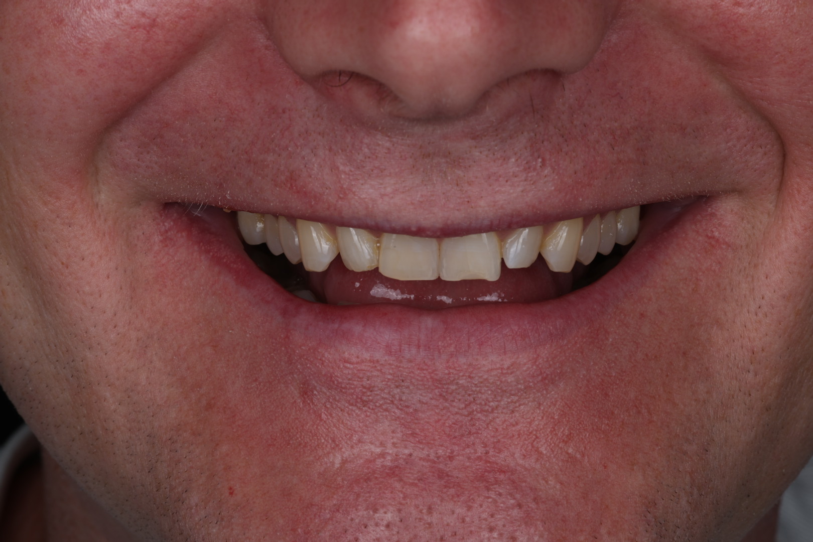 Case 02, before, smile detail