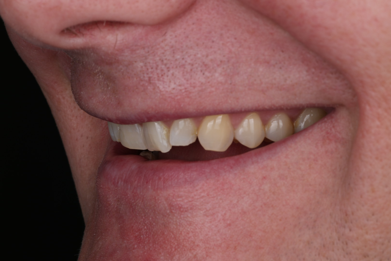Case 02, before, smile detail