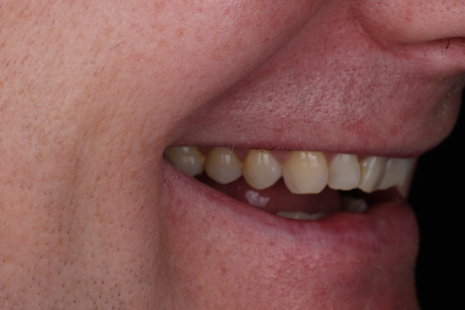 Case 02, before, smile detail