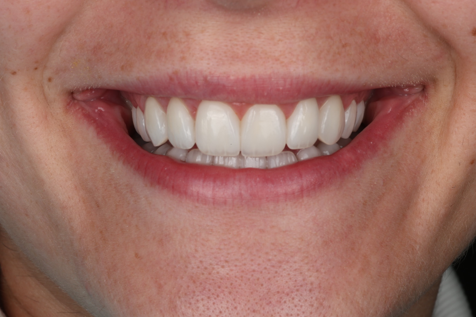 Case 04, after, smile detail