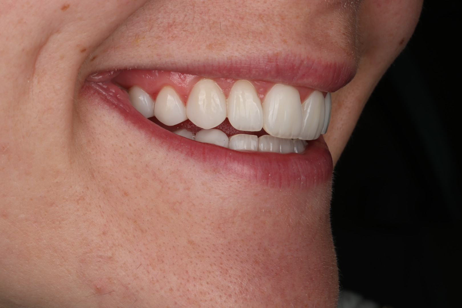 Case 04, after, smile detail