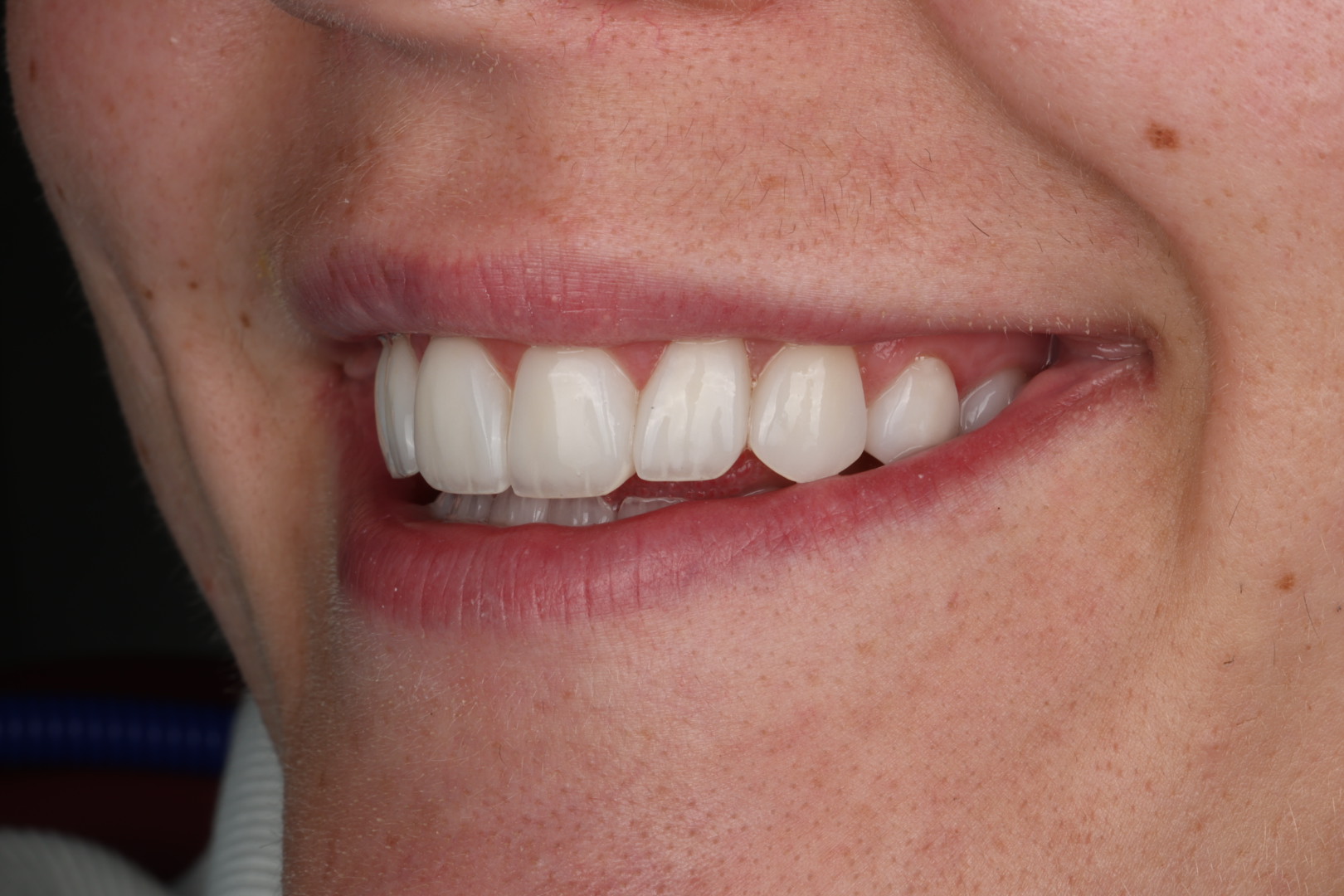 Case 04, after, smile detail
