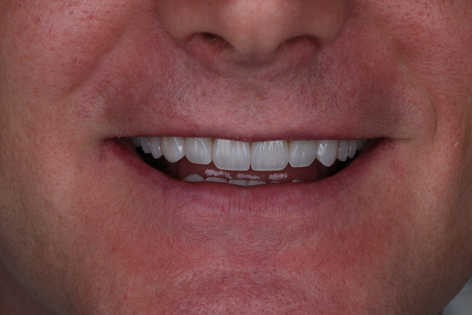 Smile transformation 02 | Dr. Parisa