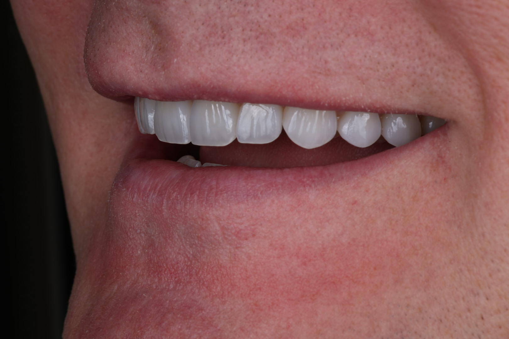 Case 02, after, smile detail
