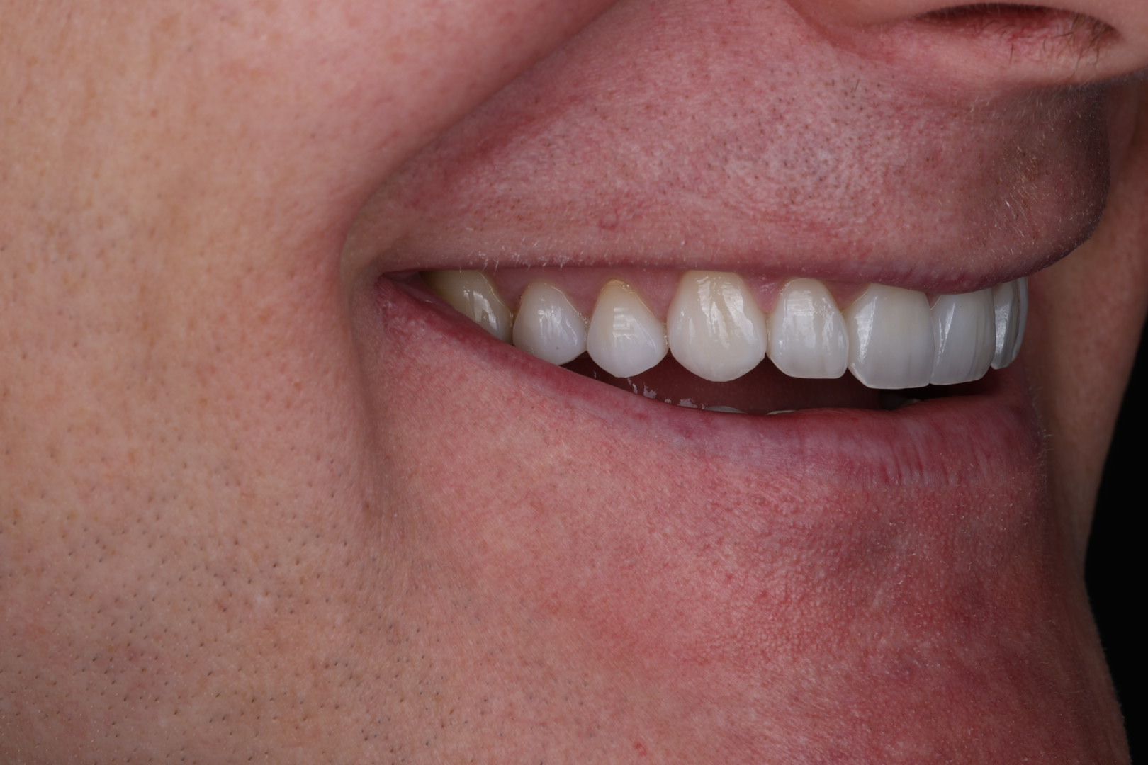 Case 02, after, smile detail