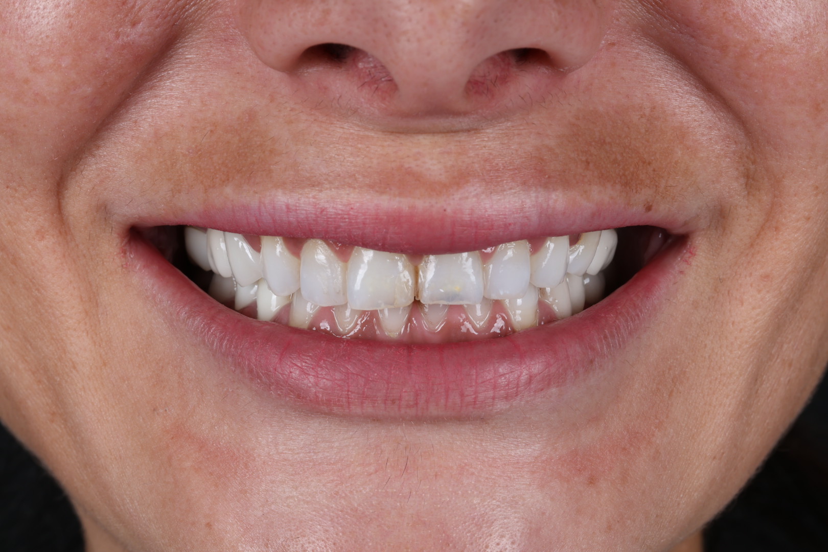 Case 01, before, front smile view