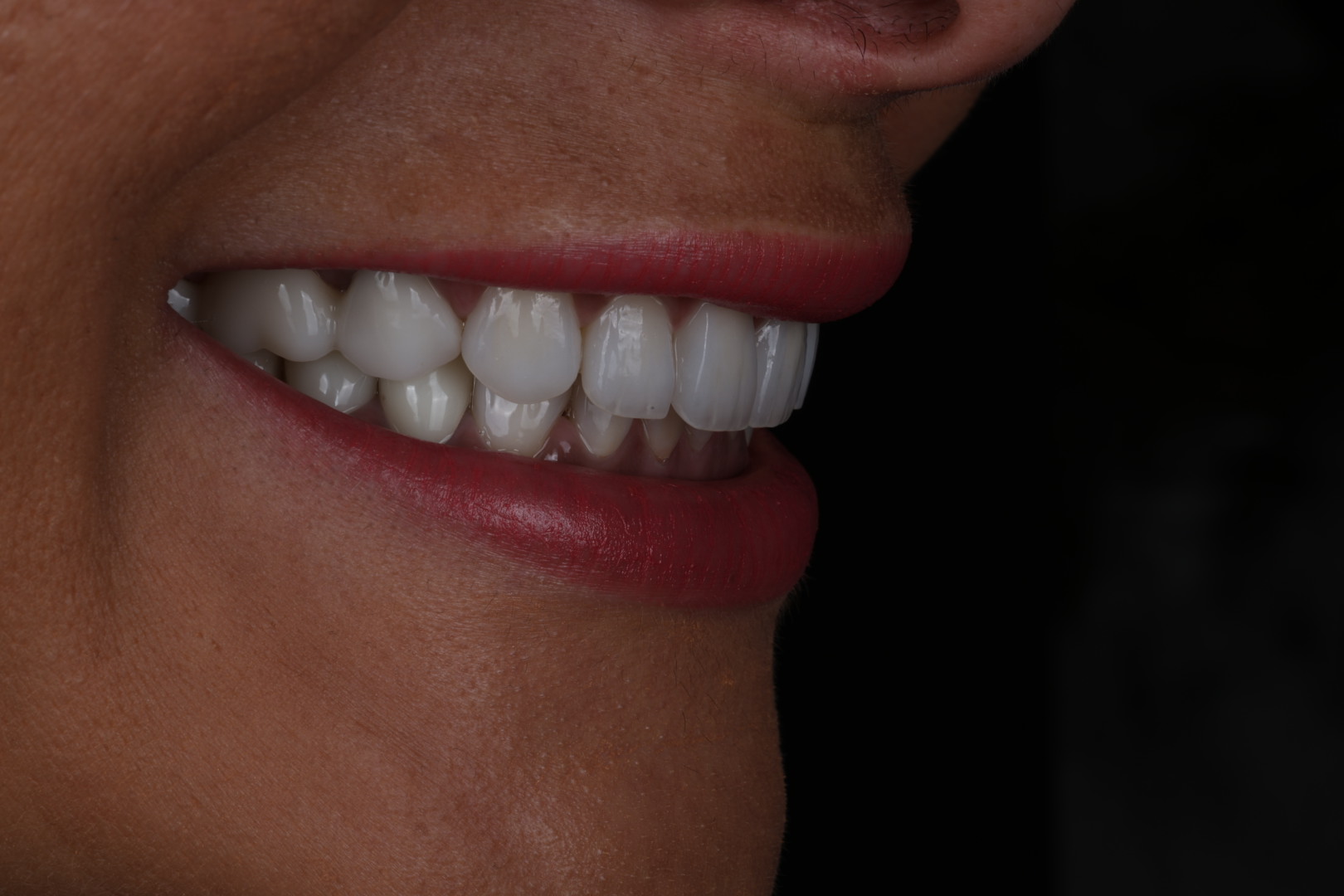 Case 01, after, angled smile view